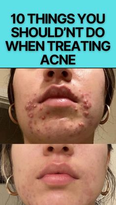 Acne Chart Causes Of, What Different Acne Spots Mean, Skincare Routine Acne Prone Skin, Food To Avoid For Acne, Things That Cause Acne, Natural Ways To Get Rid Of Acne, How To Look Good With Acne, Natural Makeup Acne Skin, Natural Ways To Clear Acne