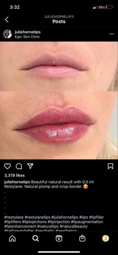 Very Natural Lip Filler, Heart Shape Lips Fillers, Lip Filler Shape Ideas Natural, Lip Filler Inspiration Natural, Lip Filler Inspo Pics, Lip Filler Shape Ideas 1ml, 1ml Lip Filler Before And After, Hip Filler