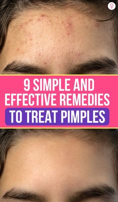 Generated Description with relevant hashtags. What Helps With Pimples, How To Get Rid Of Bumpy Forehead, How To Get Rid Of Under The Skin Pimples, How To Get Rid Of Pimples On Forehead, How To Get Rid Of Redness From Pimples, Pimples On Face Meaning, Pimple Remedies, Remedies For Pimples, Peroxide For Acne