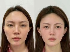 two women are shown before and after their plastic surgery