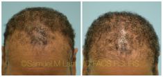 This 45-year-old African-American woman is shown before and 5 months after starting 82M to improve her hair loss. Retinoic Acid, Increase Hair Growth, Decrease Inflammation, Stimulate Hair Growth, Restoration Services, American Woman