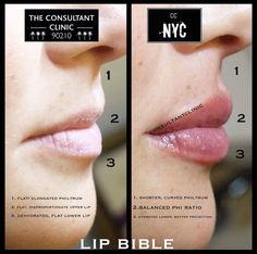 Downturned Lips Filler, Lip Filler Downturned Lips, 1 Ml Lip Filler Before And After, 0.5 Ml Lip Filler Before And After, Natural Lip Fillers, Nose Surgery Rhinoplasty, Facial Procedure, Lips Inspiration