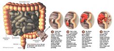 Colon Problems, Sigmoid Colon, Lymph System, The Digestive System, Colon Health, Solid Waste, Types Of Cancers, Digestive System