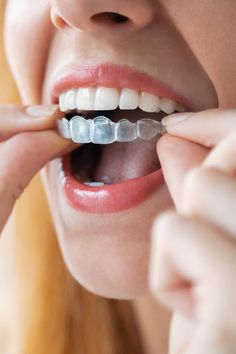 Teeth Alignment, Remedies For Tooth Ache, Loose Tooth, Diy Teething, Teeth Straightening, Clear Aligners, Perfect Smile, Oral Health Care