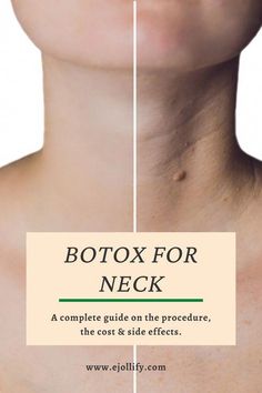 Learn how Botox works to treat necklines and neck wrinkles and what to expect from the treatment. Neck Fillers Before And After, Botox Locations On Face, Neck Tightening Procedures, Botox In Neck, Botox Neck Before After, Neck Botox Before And After, How To Remove Neck Lines, Botox Areas On Face, Natural Botox For Face