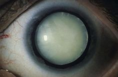 an eyeball is shown in close up to show the iris's white and black markings