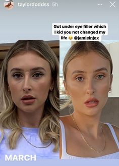 #plasticsurgery #plasticsurgerygonewrong #beforeafter #celebritiesbeforeafter #hollywoodstars #bignosesurgery #surgery #facesurgery #vlinesurgery #koreanplasticsurgery #kpopplasticsurgery #nosejob #jawreductionsurgery #eyesurgery #cheekfillers #rhinoplasty #facelift #plasticsurgeryfails #expensiveplasticsurgery Check Filler Before And After, Nasal Fold Filler Before And After, Undereye Fillers Before And After, Prp Undereye Before And After, Undereye Filler Before And After, Tear Trough Filler Before After, Blephoraplasty Before And After, Under Eye Filler Before And After, Esthetic Procedures