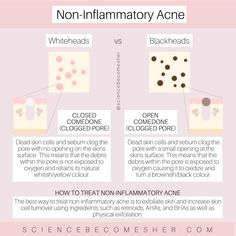 Acne Infographic, Advanced Esthetics, Skin Notes, Inflammatory Acne, Skin Analysis, Acne Treatments, Natural Acne Remedies