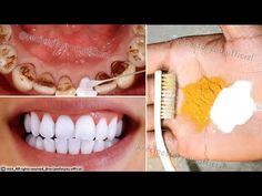 Secret that Dentists don't want you to know: Remove Tartar and Teeth Whitening in just 2 minutes - YouTube Baking Soda Teeth, Natural Teeth Whitening Diy, Natural Teeth Whitening Remedies, Baking Soda Teeth Whitening, Teeth Whitening Homemade, Black Teeth, Teeth Whitening Remedies, Teeth Whitening Diy, Teeth Health