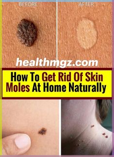 How To Get Rid Of Skin Moles At Home Naturally

#health #remedy #skin Skin Moles, Mole Removal, Unhealthy Diet, Organic Apple Cider, Pink Skin, Skin Tissue, Hormonal Changes, Even Skin Tone, Simple Tricks