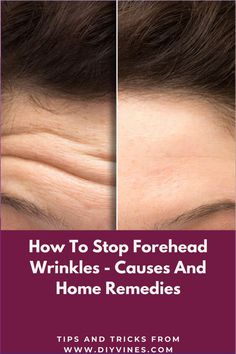 Discover effective tips to stop forehead wrinkles before they deepen. With natural remedies, skincare routines, and lifestyle changes, you can reduce fine lines and maintain smoother, more youthful-looking skin.