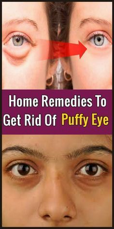 Swollen Eyelid, Bags Under Eyes, Baggy Eyes, Dark Circle Remedies, Swollen Eyes