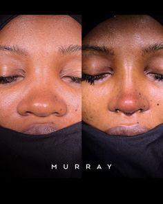 Face Surgery, Facial Surgery