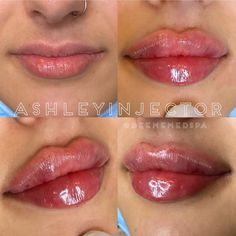 Perfect Nose, Lip Augmentation, Injectables Fillers