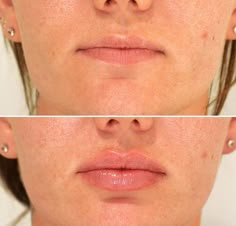 Small Lip Filler, Lip Filler Side Profile, Lip Filler Before And After 1ml, Lip Fillers Shapes, Lip Filler Before And After, Lips Shape