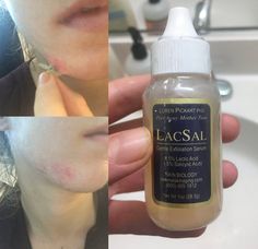 How Does LacSal Serum Work to Heal and Exfoliate Skin? The skin heals in layers, and exfoliation using lactic acid and salicylic acid is one way to take off the top damaged layer of skin, including but not limited to skin damage caused by acne scarring, to reveal healthy skin underneath. The LacSal serum is a clear serum you can easily wear during the day. It is an effective exfoliation agent made up of 8.5% lactic acid and 1.5% salicylic acid that work to break down damaged skin so the undernea Skin Biology, Exfoliating Serum, Aloe Vera Powder, Exfoliate Skin, Acne Scarring, Copper Peptides, Skin Structure, Polysorbate 80, Dry Sensitive Skin