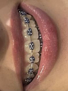 Braces Bottom Teeth Only, Braces Colors On Teeth, Braces With Missing Teeth, Grey Braces Teeth, Aesthetic Braces Color, Color Braces Ideas, Periwinkle Braces, Teeth Braces Aesthetic, Braces Aesthetic Colors