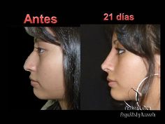 Rinoplastia, Cirugía de la Nariz | Cirugía Plástica Estética y Reconstructiva México Noise Job, Nose Plastic Surgery, Facial Procedure, Nose Reshaping