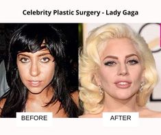 celebrity plastic surgery lady gaga before and after