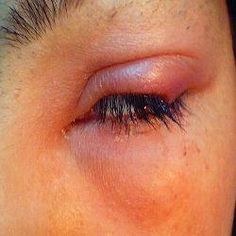 Stye Remedies Fast How To Get Rid, Eye Sty, Stye Remedies Fast, Stye Remedy, Eye Stye Remedies, Homemade Face Moisturizer, Homemade Moisturizer, Applying False Eyelashes