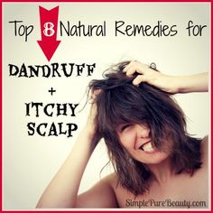 How To Remove Dandruff, Thick Hair Remedies, Getting Rid Of Dandruff, Hair Dandruff, Hair Remedies For Growth