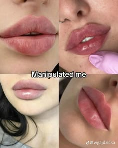 Lip Lift Before And After, Big Lips Tutorial, Cupids Bow Lips, Russian Lips, Big Lips Natural, Lip Surgery, Hyaluronic Acid Lips, Lip Lift, Lips Inspiration