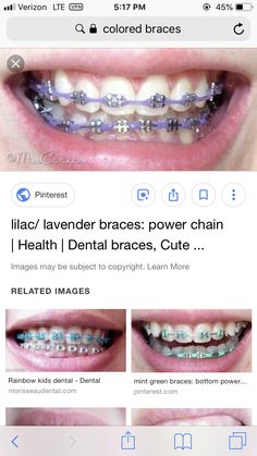 Lilac Braces, Light Purple Braces, Lavender Braces, Powerchain Braces Color, Purple Braces, Braces Colors Aesthetic, Power Chain Braces