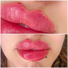 Lip Enhancement, The Details