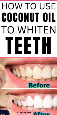 Dental Health Dentistry Motivation, Teeth Tips, Natural Teeth Whitening Diy, Teeth Whitening Homemade, Nose Picking, Discolored Teeth