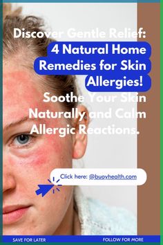 Home Remedies for Bee Stingshttps://animalpestcontrols.com/14-effective-home-remedies-for-bee-stings/If you get stung by a bee, don't panic! There are plenty... Allergies Remedies, Home Remedies For Allergies, Cold Or Allergies, Heart Burn Remedy, Skin Allergy, Inflamed Skin, Home Remedies For Skin, Allergy Remedies, Best Lotion