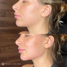 Cheek And Jaw Fillers, Jaw Line Botox Before And After, Botox For Slimmer Face, Jaw And Chin Filler Before And After, Before And After Jaw Filler, Jaw Contouring Filler, Jawline Contouring Filler, Facial Symmetry Filler