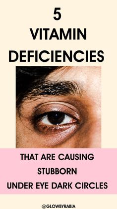 What deficiencies causes under eye dark circles ? This question is answered by a pharmacist to ensure your diet is optimised to reduce dark circles fast Dark Under Eyes, How To Cover Dark Circles Under Eyes, Dark Circles Under The Eyes Remedies, Natural Dark Circle Remedy, Darkness Under Eyes, Dark Under Eye Circles, Under Eye Dark Circles, Remove Eye Wrinkles, Dark Circles Around Eyes