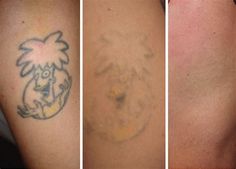 before and after photos of laser tattoo removal