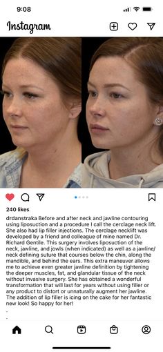 Face Lipo Before And After, Facial Lipo Before And After, Neck Lipo Before And After, Types Of Jawlines, Jowl Lift Fillers, Botox Face Lift, Chin Fillers Before After