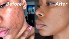 Black Skin Care Dark Spots, Pigmentation Remedy, Maquillage On Fleek, How To Fade, Hyper Pigmentation, Black Skin Care, Skin Spots