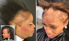 Atlanta hairstylist shares videos of clients suffering from hair loss due to weaves Bad Hairline, Hairstyles For Hair, Losing Hair Women, Black Hair Growth, Edges Hair, Regrow Hair, Athletic Hairstyles