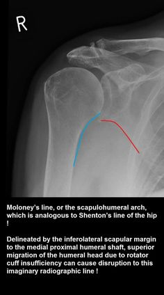 an x - ray shows the shoulder with red and blue lines