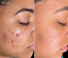 Pimple Solution, Causes Of Acne, Heart Diet, Acne Face, Acne Skincare, Face Chart, Acne Solutions