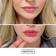 Russian Lips Filler Before And After, Russian Lips Filler, Lip Fillers Juvederm, Russian Lips, Lips Fillers, Port Credit, Rhinoplasty Nose Jobs, Lip Care Tips