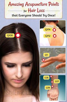 Woman Health, Point Acupuncture, Male Pattern Baldness, Pattern Baldness, Home Remedies For Hair, Women's Hair, Stop It