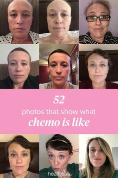 My Chemotherapy Diary: 52 Photos of Hair Loss and Recovery #hairlossremedy Herbs For Hair, Brown Spots On Face, Home Remedies For Hair, Essential Oils For Hair, Hair Prom, Hair Braids, Braids Hairstyles, Get A Tattoo