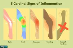 Inflammation is characterized by five cardinal signs: redness, heat, swelling, pain, and loss of function. Learn more about the signs and symptoms. Musculoskeletal Disorders, Cardinal Signs, Home Remedies For Bronchitis, Cushings Syndrome, Signs Of Inflammation, Body Inflammation, Low Estrogen Symptoms, Too Much Estrogen, Inflammation Causes