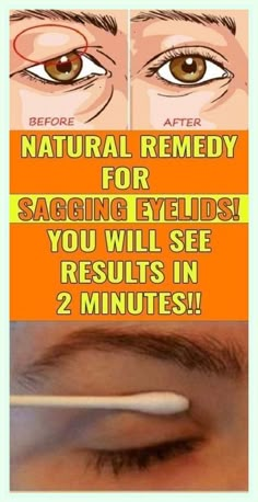 Saggy Eyelids, Sagging Eyelids, Droopy Eyelids, Skin Natural Remedies, Beauty Remedies, Mascara Facial