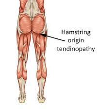 the muscles are labeled in this diagram, including hamstring origin and tendinopathhy