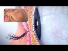 Eye Animation, Coconut Health Benefits, Blurry Vision, Benefits Of Coconut Oil