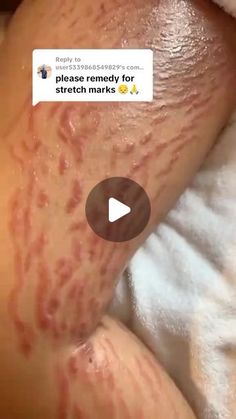 Stretch Mark Remedies, Stretch Mark Cream, Stretch Mark, Follow Us, Cream, On Instagram, Instagram