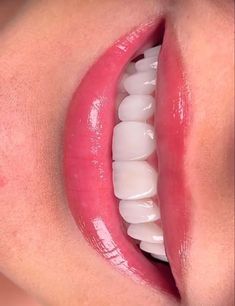 Perfect Teeth Vision Board, Pretty Teeth Aesthetic, Perfect Smile Aesthetic, Beautiful Teeth Smile, Perfect Teeth Aesthetic, Pretty Smile Aesthetic, White Teeth Aesthetic, Veneers Aesthetic