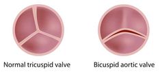 Bicuspid Aortic Valve - Symptoms, Diagnosis, Treatment & Surgery Heart Facts, Tricuspid Valve, Enlarged Heart, Congenital Heart Defect