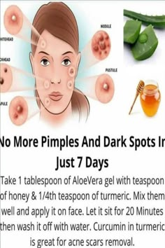 Clear Pimples Overnight, Clear Pimples, To Remove Pimples, Pimple Solution, How To Clear Pimples, Blind Pimple, Remove Pimples, Pimples Under The Skin, Pimple Scars