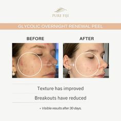 Glycolic Overnight Renewal Peel with Mandelic + Niacinamide (1oz/30ml) – Pure Fiji US Store Mandelic Acid, Luminous Skin, Dry Face, Anti Aging Ingredients